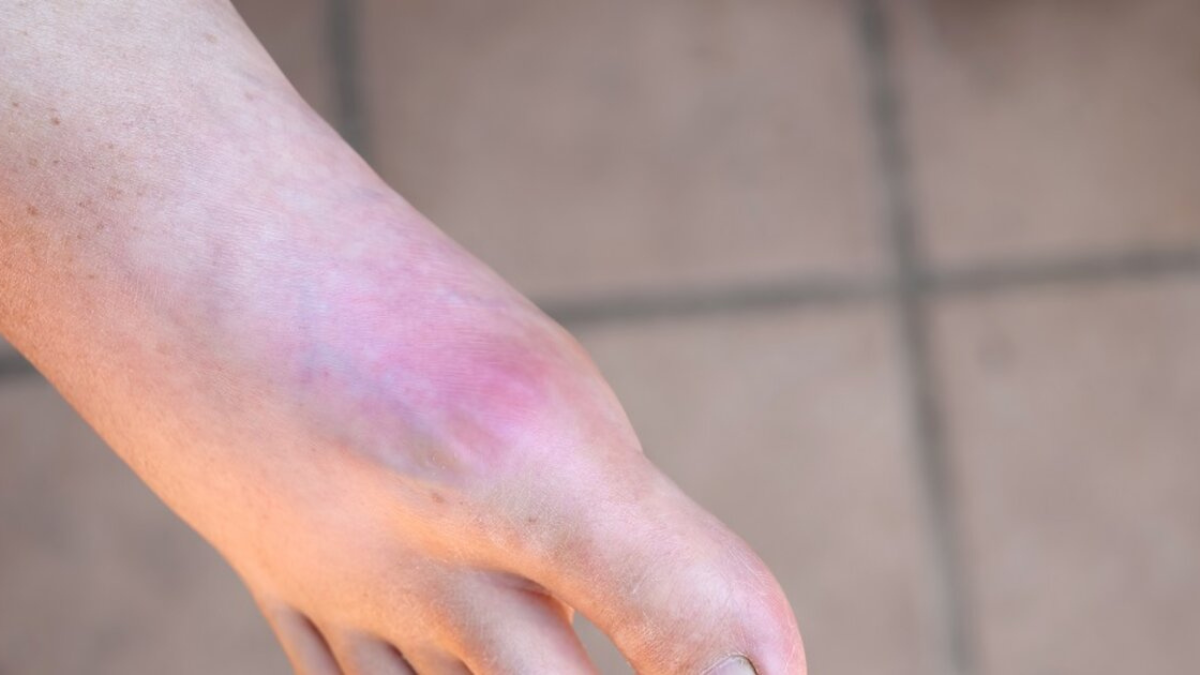 Gicht im Fuß Bilder: So sieht ein akuter Gichtanfall im Fuß wirklich aus