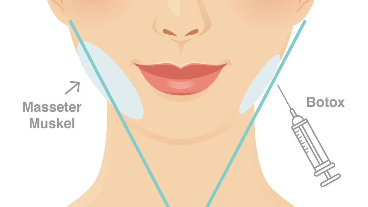 Masseter Botox vorher nachher: So stark verändert sich dein Gesicht wirklich
